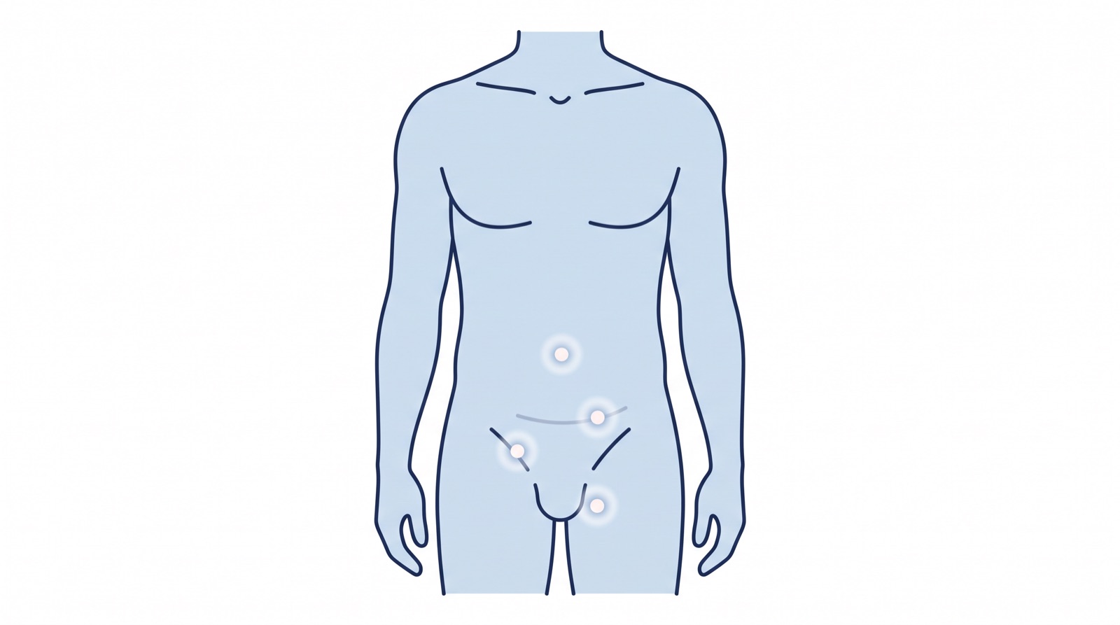 Illustration of an adult torso marking the common places hernias occur: the groin, the belly button, and an old incision scar