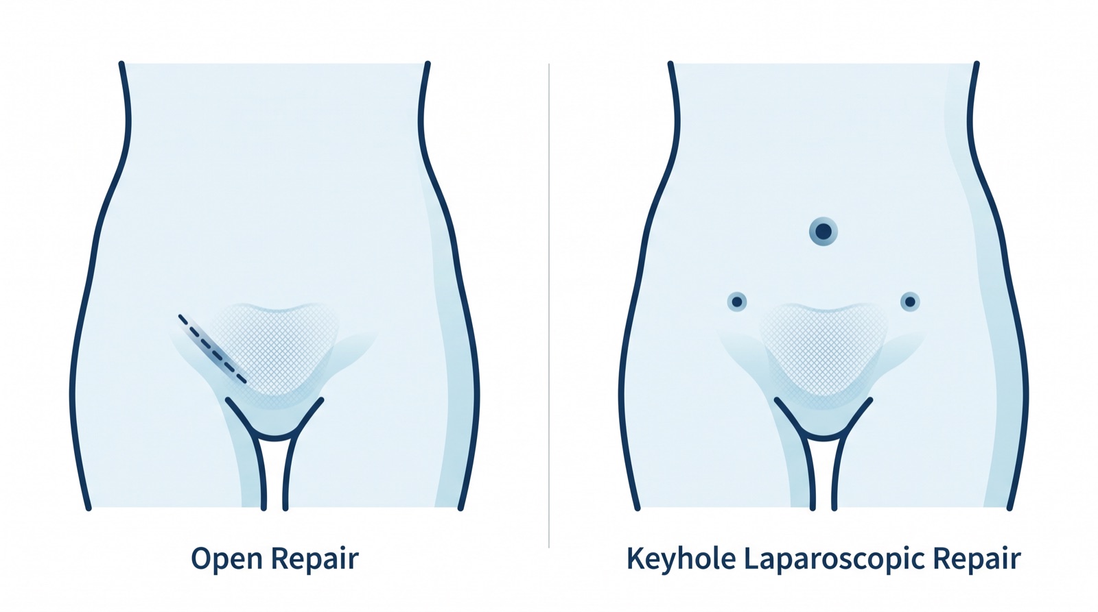 Side-by-side illustration comparing open hernia repair through one groin incision with keyhole laparoscopic repair through three small openings, each reinforced with mesh