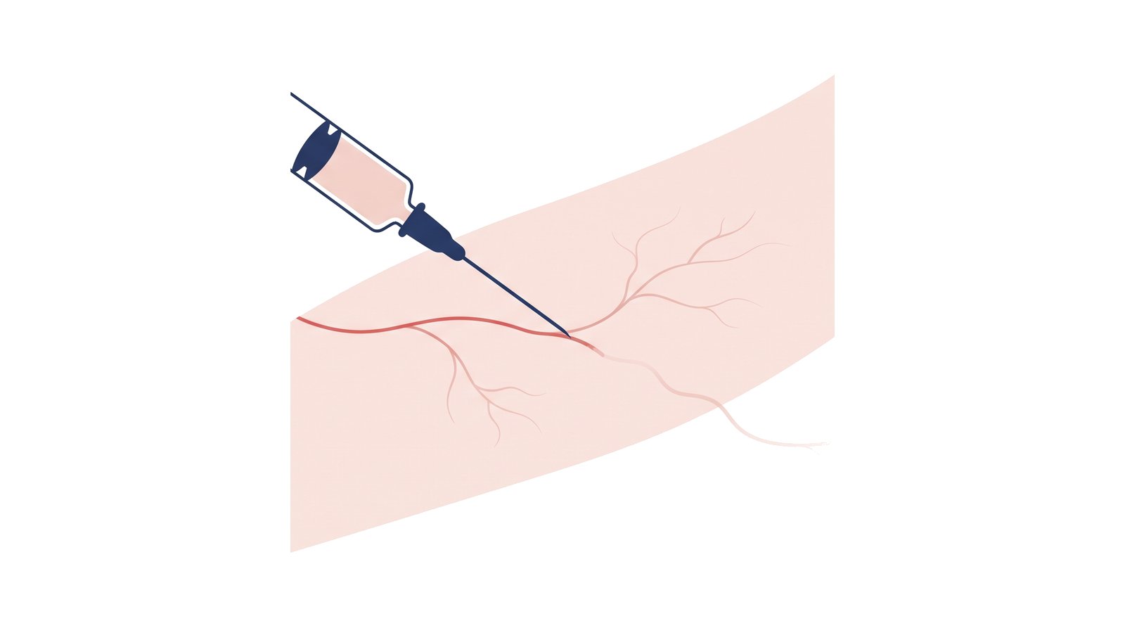 Illustration of sclerotherapy, a fine needle treating a thin surface vein