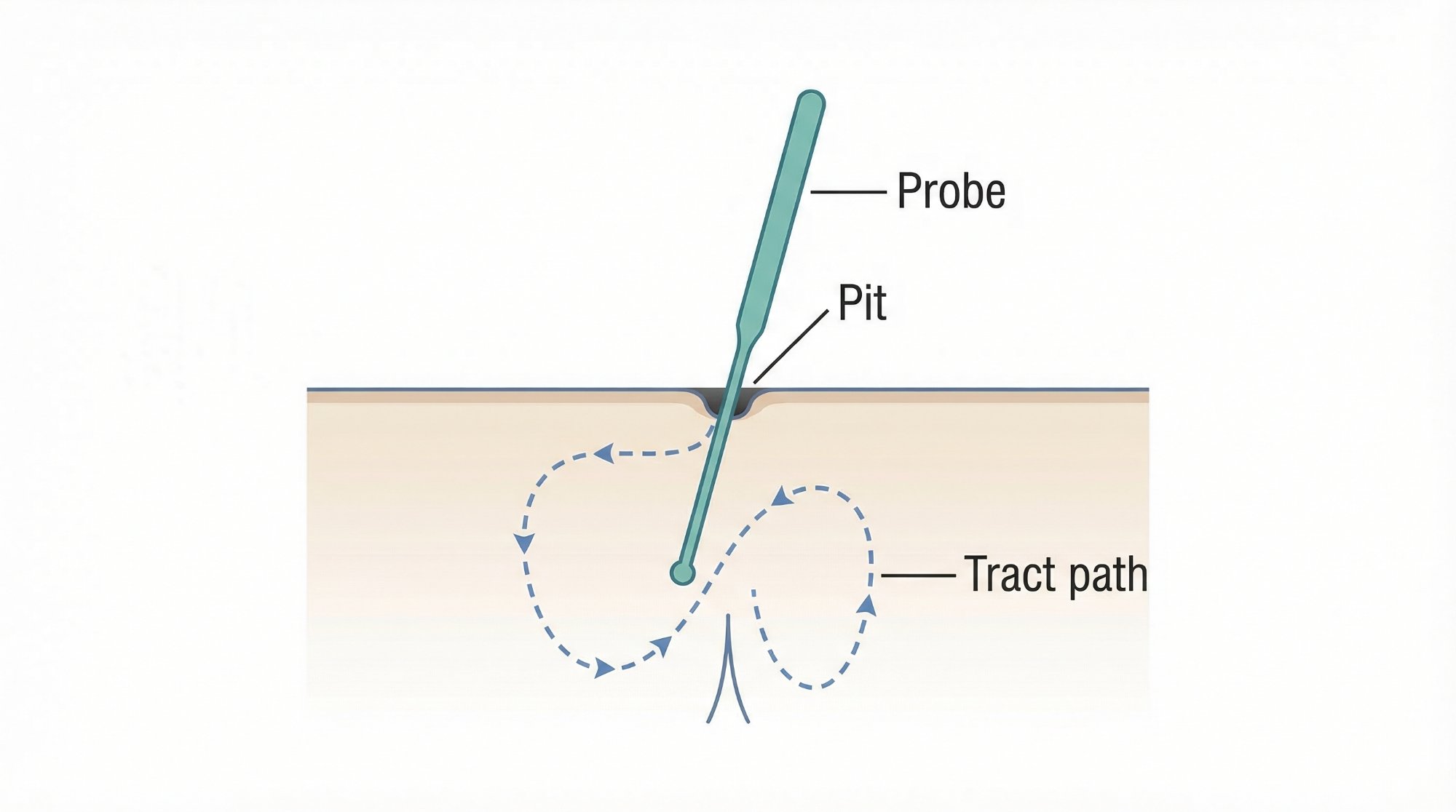 Step 1: Probe inserted into pit opening, mapping the sinus tract path beneath the skin surface