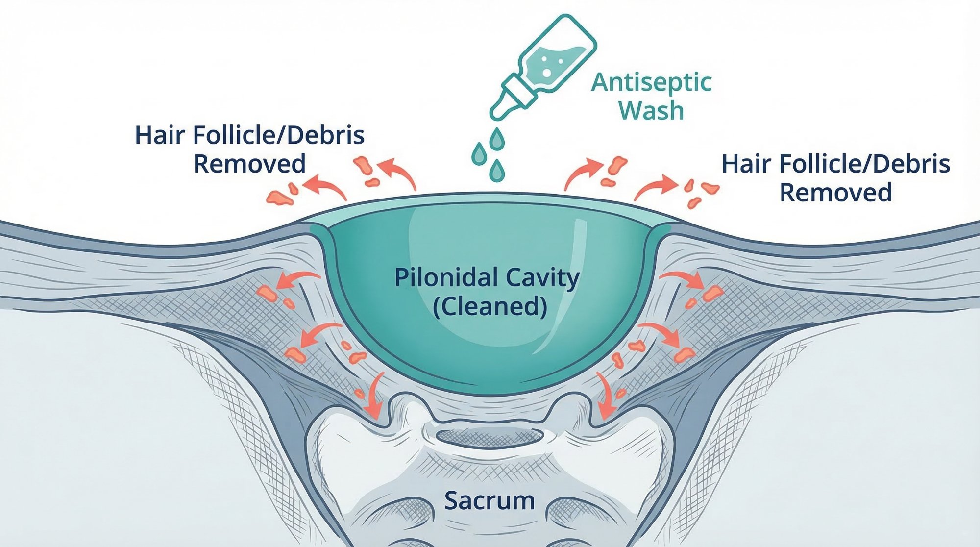Step 3: Cleaned pilonidal cavity with hair follicle and debris removed, antiseptic wash applied, sacrum visible beneath